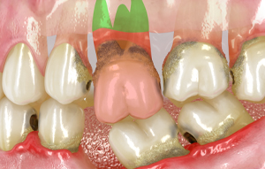 La prótesis dental removible